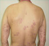 Psoriasis before homeopathic treatment