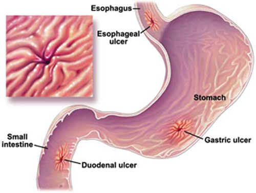 Peptic ulcers are categorized into two types: A peptic ulcer in the stomach is called a gastric ulcer. If the ulcer develops in the small intestine, it is named for the section of the intestine where it develops. The most common is a duodenal ulcer, which develops in the first part of the small intestine.